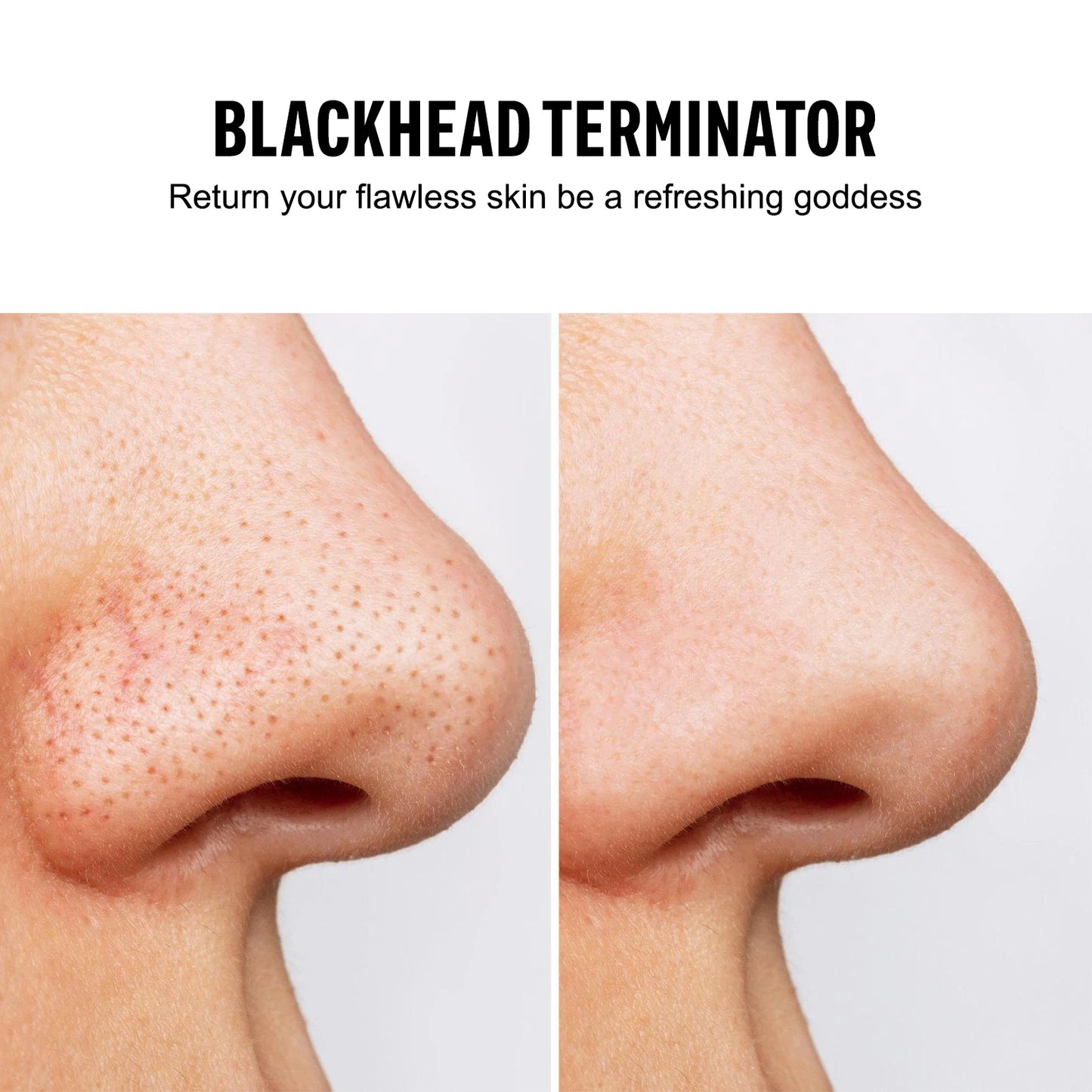 Blackhead Remover & Pore Vacuum (USB Rechargeable)