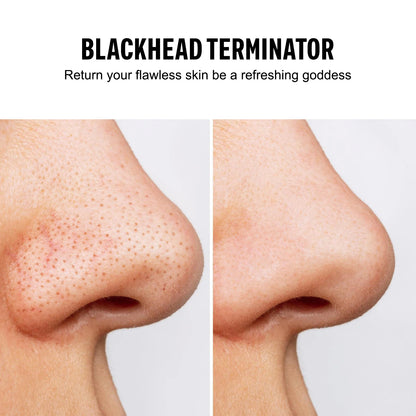 Blackhead Remover & Pore Vacuum (USB Rechargeable)